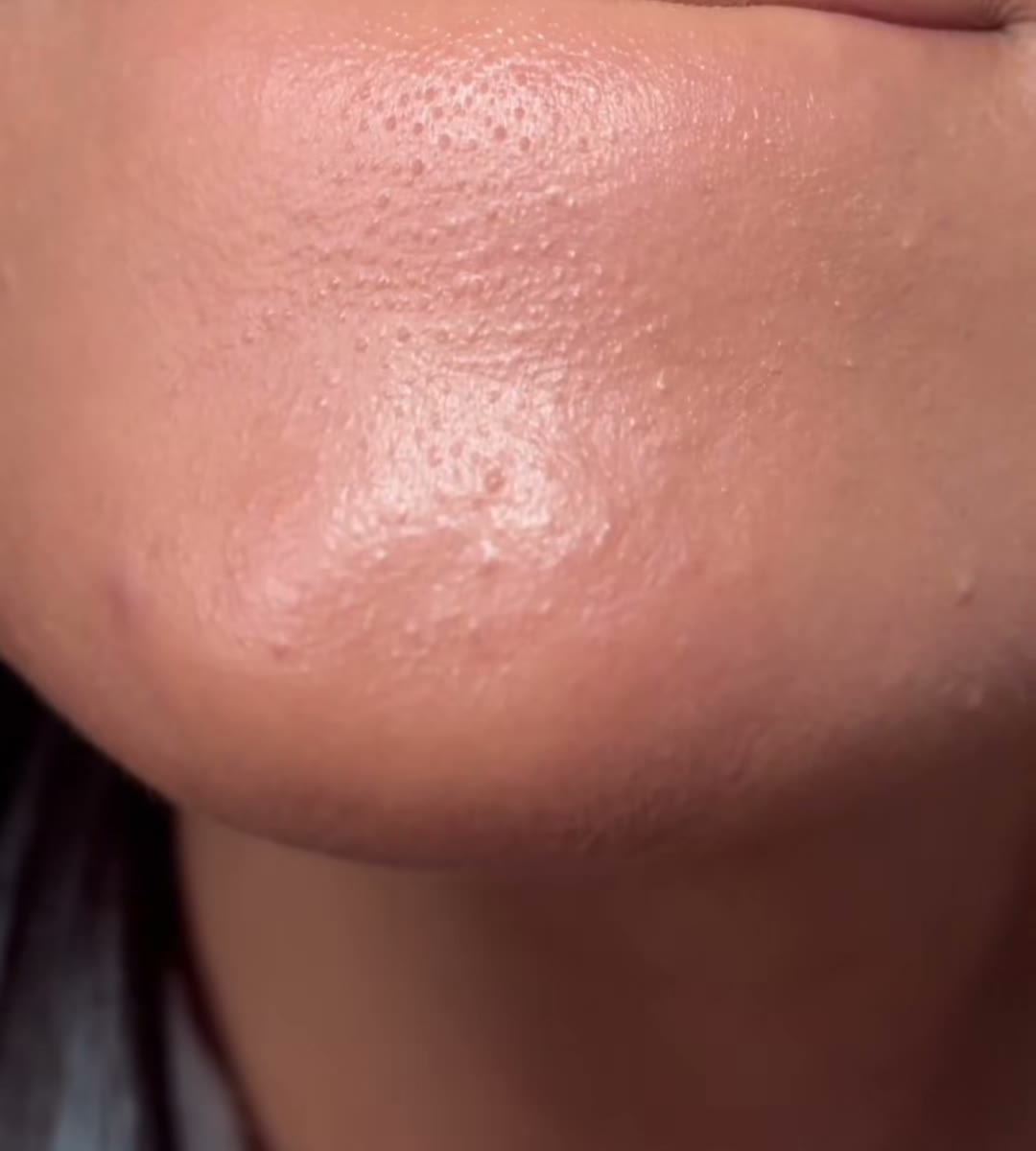 This is what my chin looked like on a normal day before I fixed my (medicube Zero Pore Double Cleansing Duo, Aerely Chacón)