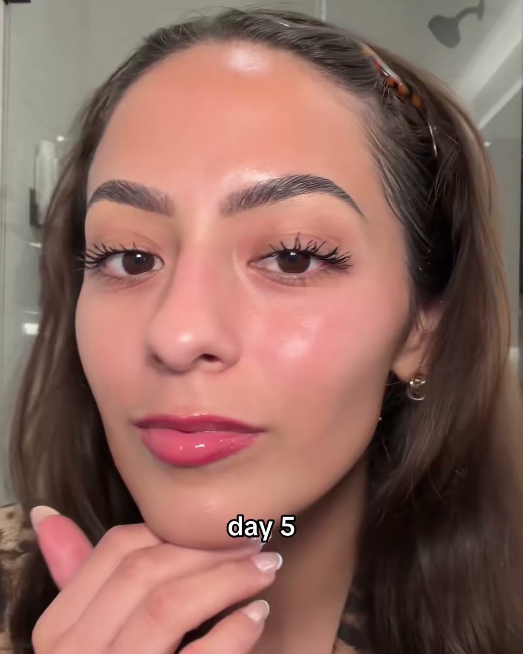 Day 5, same forehead, no filter and no makeup on it. The marker patch is gone (medicube Zero Pore Pad 2.0, Aerely Chacón)