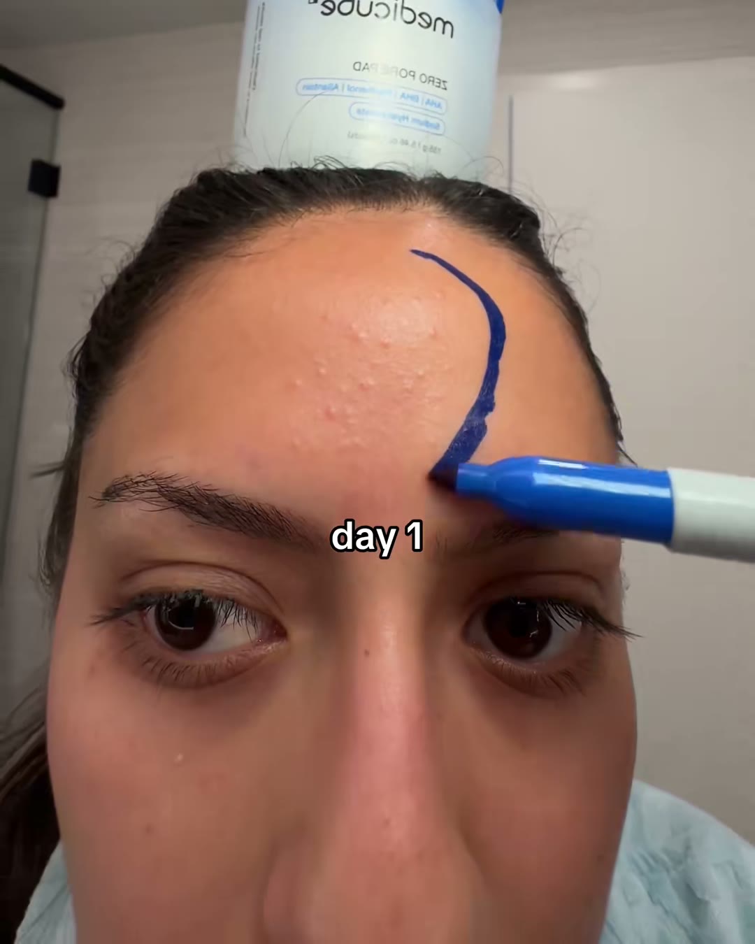 Day 1. I circled the exact patch so I could not pretend later that it moved (medicube Zero Pore Pad 2.0, Aerely Chacón)